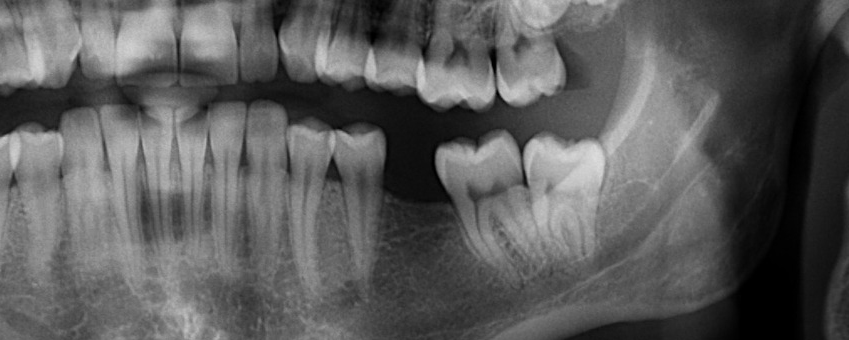 tooth extractions Fort Collins pediatric dentist