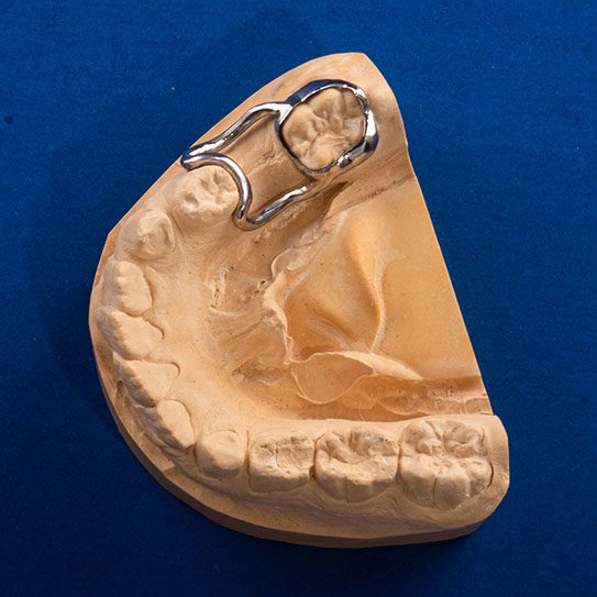 pediatric dentist in Fort Collins space maintainers