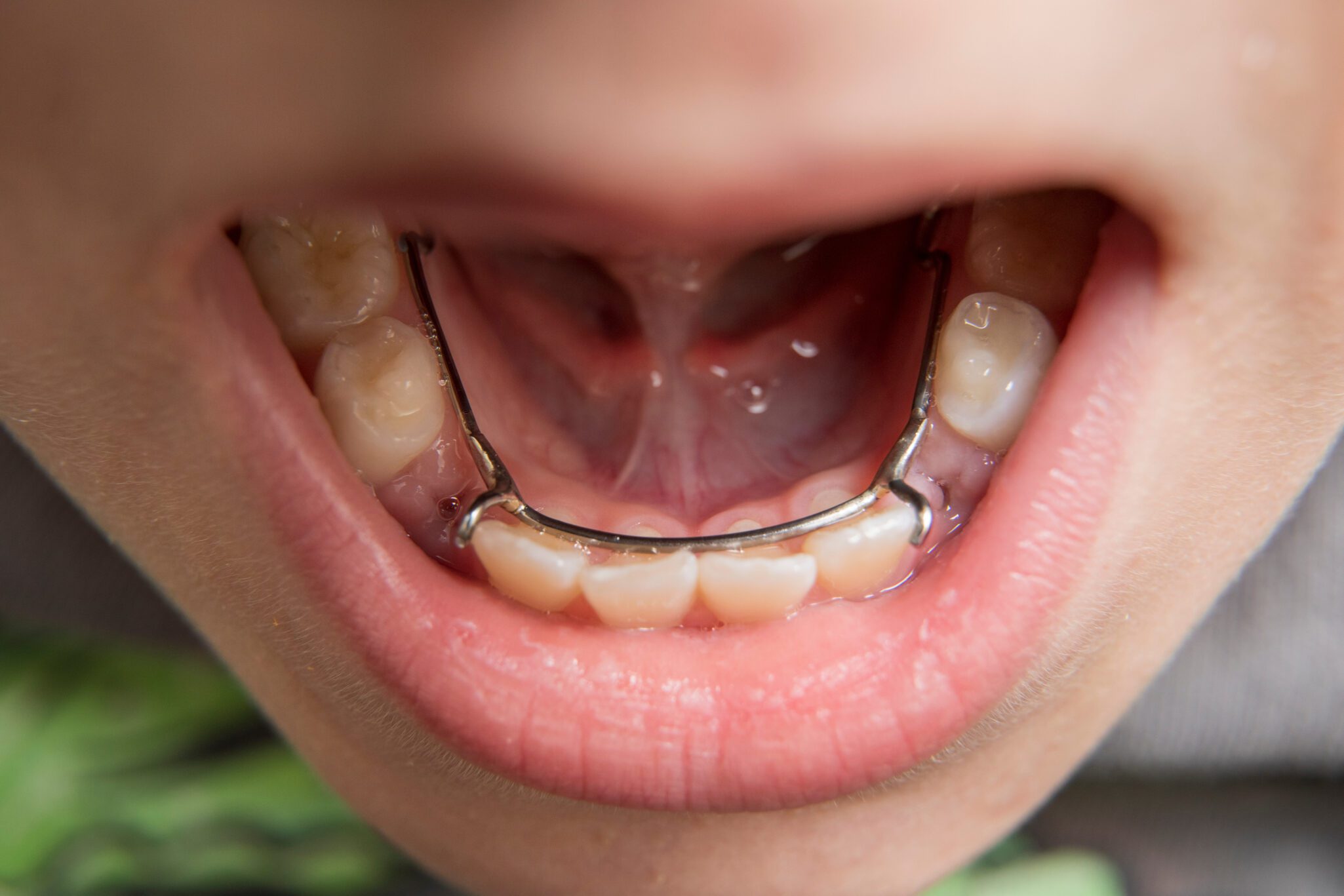 interceptive orthodontics Fort Collins dentist