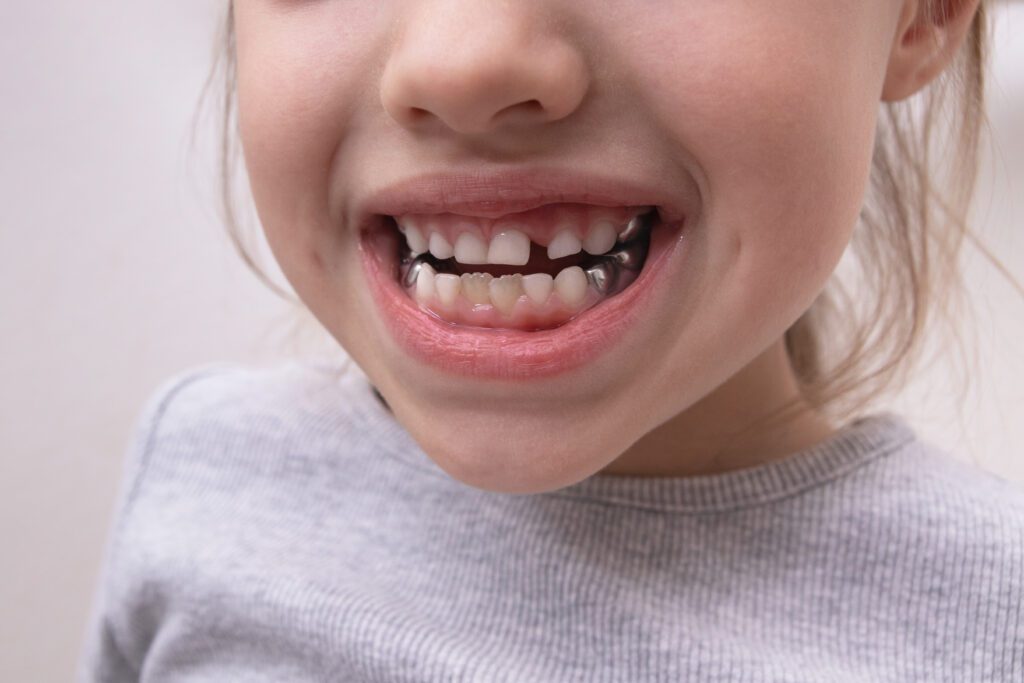pediatric dental crowns dentist Loveland dentist Fort Collins